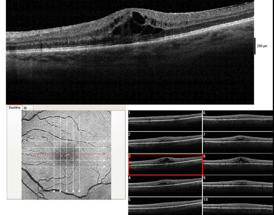 NSAID Monotherapy Day of Cataract Surgery